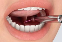 Коррекция уздечки языка: когда нужна операция