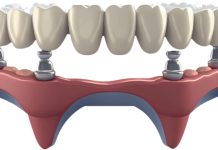 All-on-4 под ключ: ваша новая улыбка