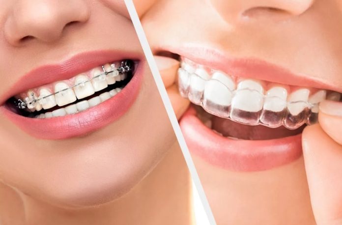 Брекеты vs Элайнеры
