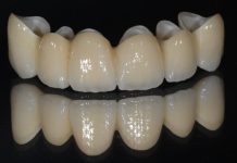 Коронки на передние зубы: цена или качество?