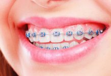 Брекеты для подростка: раскрываем все секреты