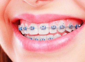 Брекеты для подростка: раскрываем все секреты